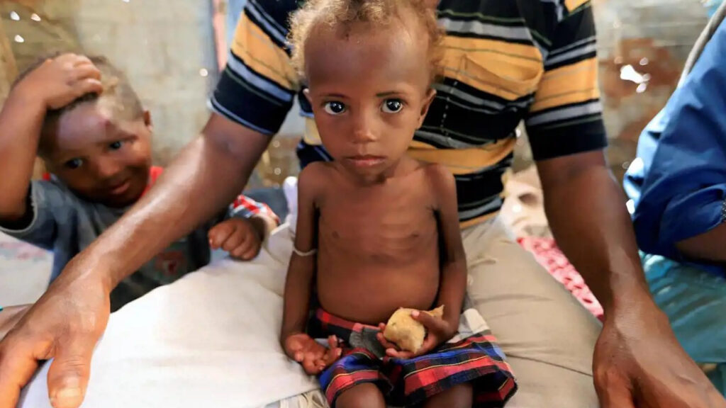 yemende-kizamik-vakalarinda-patlama-36-cocuk-oldu-5fcdVXGl