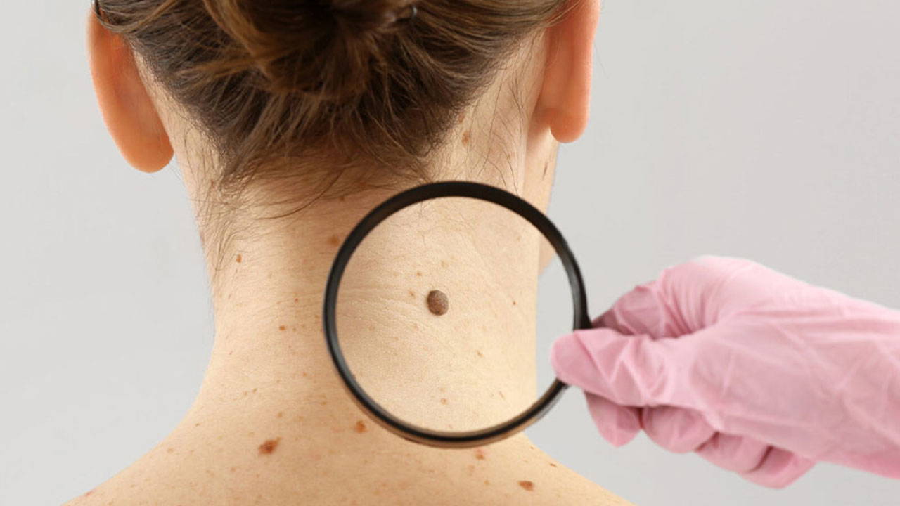 dermatoloji-uzmani-acikladi-benlerdeki-degisiklikleri-hafife-almayin-RKeriGEu